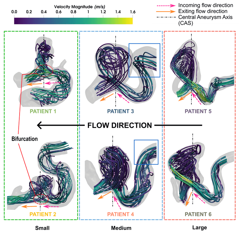 Modal analysis of blood flows in saccular aneurysms